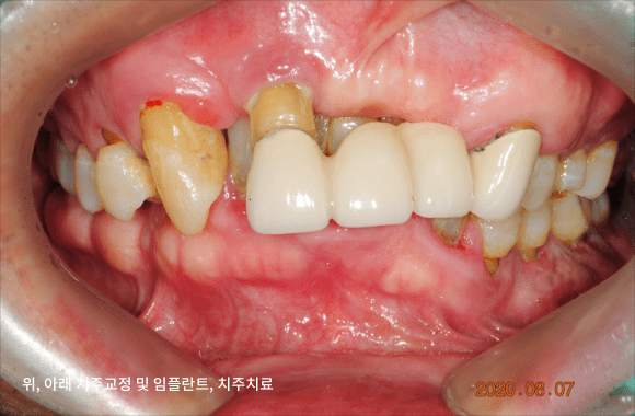 시니어 부분교정