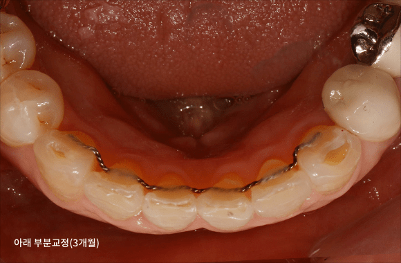 시니어 교정+임플란트