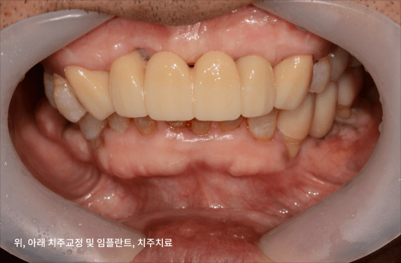 시니어 부분교정