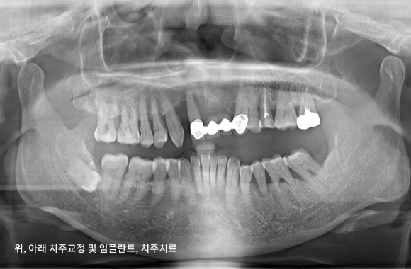 시니어 부분교정