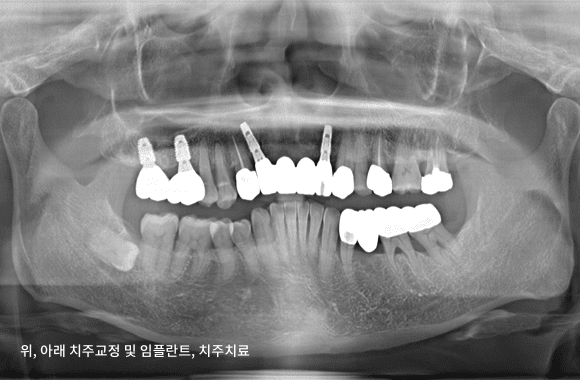 시니어 부분교정