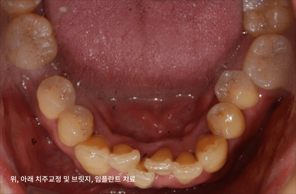 시니어 부분교정