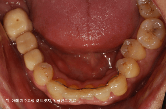 시니어 부분교정