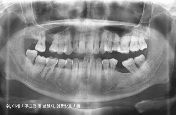 시니어 부분교정