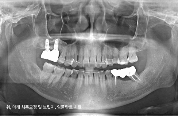 시니어 부분교정